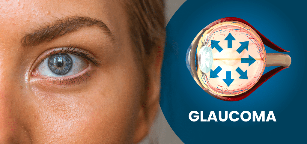 Glaucoma Awareness